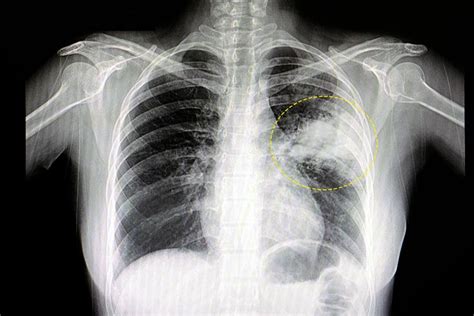 raio x de pulmão com pneumonia